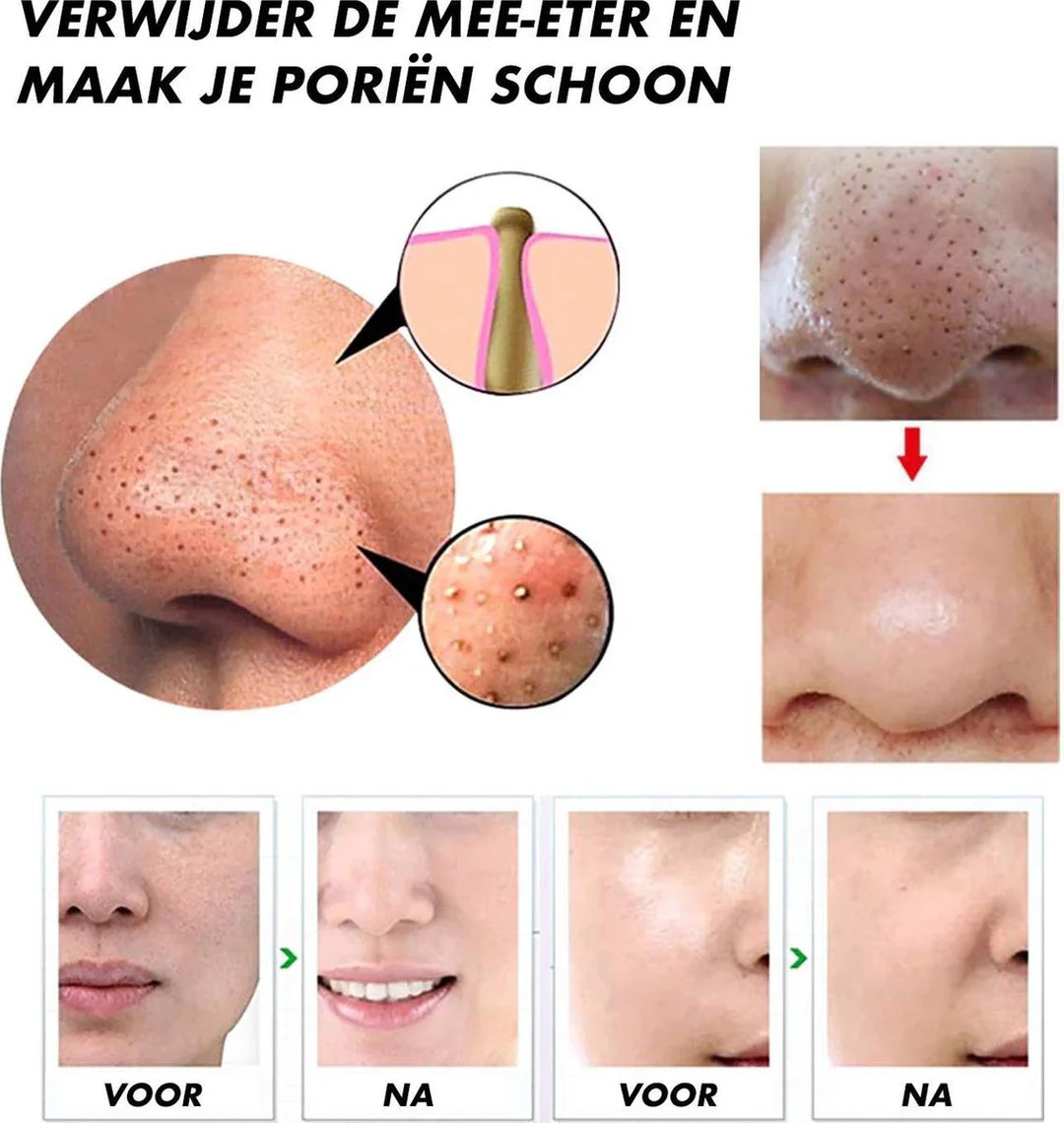 Skanto | Elektrisk Blackhead Fjerner