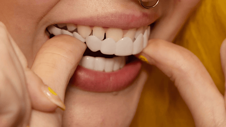 Sofortige Verschönerung Ihres Lächelns med Snap-on-Veneers