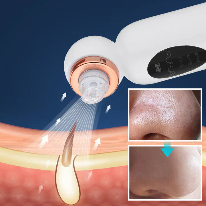 Skanto | Blackhead Remover og Hydrodermabrasjonsenhet