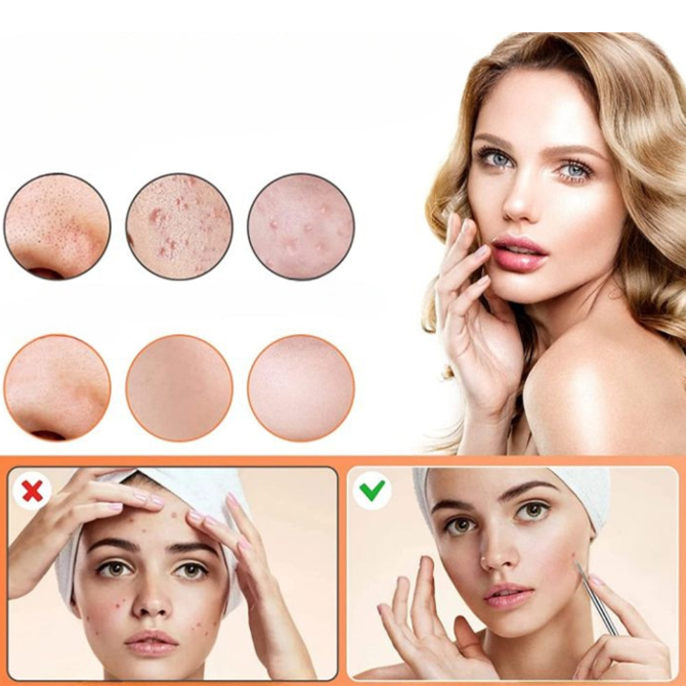 Skanto | Rustfritt stål blackhead remover pimple popper verktøysett med metallboks