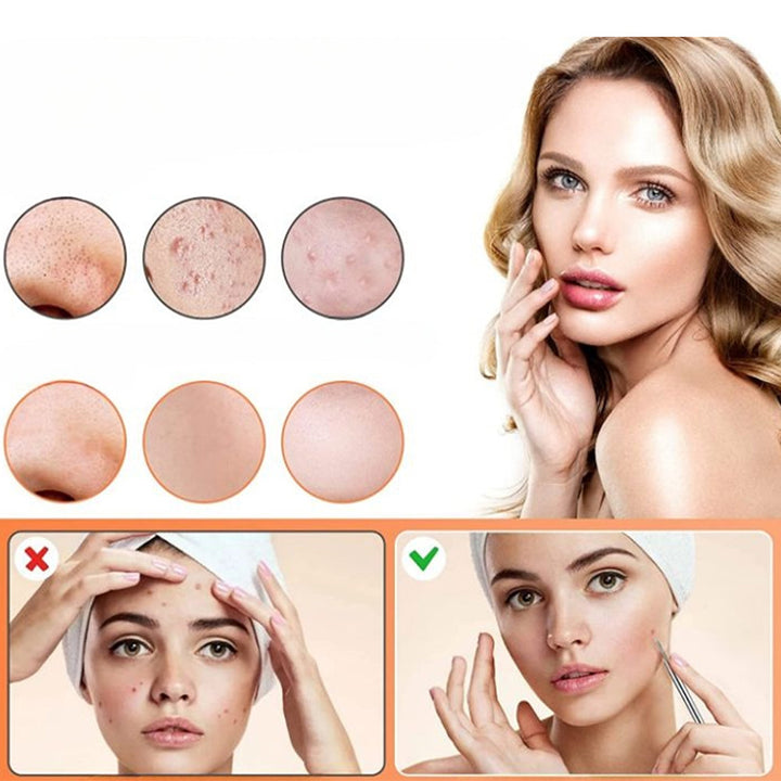 Skanto | Rustfritt stål blackhead remover pimple popper verktøysett med metallboks