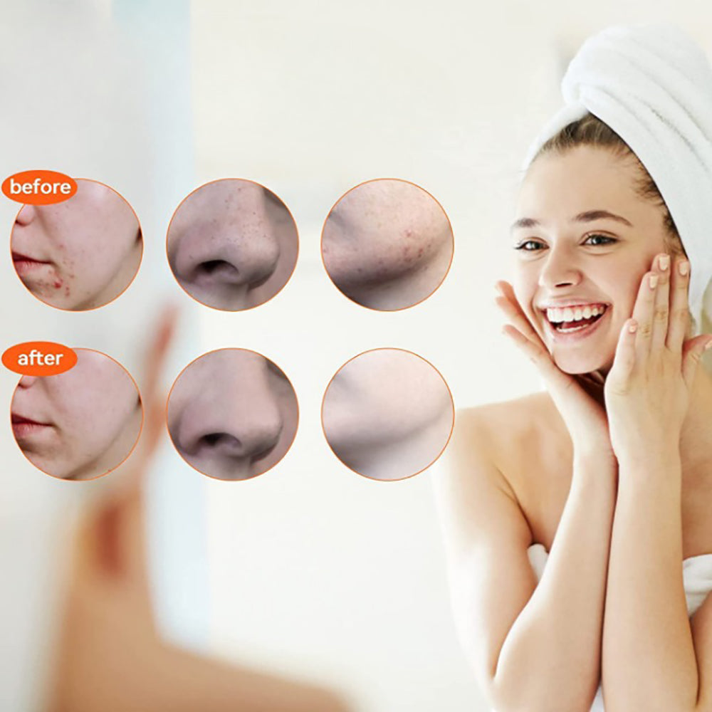 Skanto | Rustfritt stål blackhead remover pimple popper verktøysett med metallboks