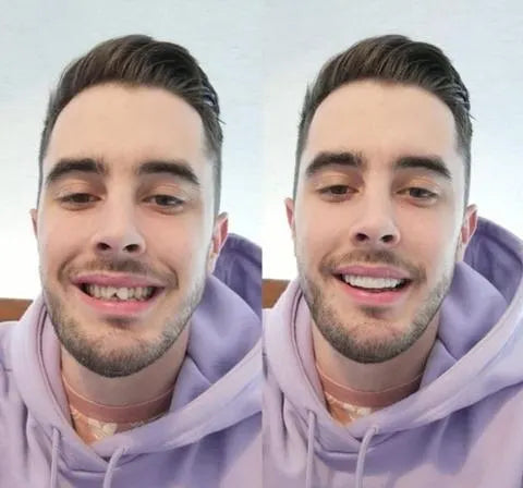 Skanto | På Smile Veneers (Øvre og Nedre Kjeve inkludert)