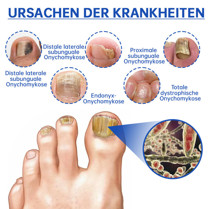 Skanto | PureNail™ | Neglesopp Laserbehandling Enhet - Ditt hemmelige våpen mot neglesopp