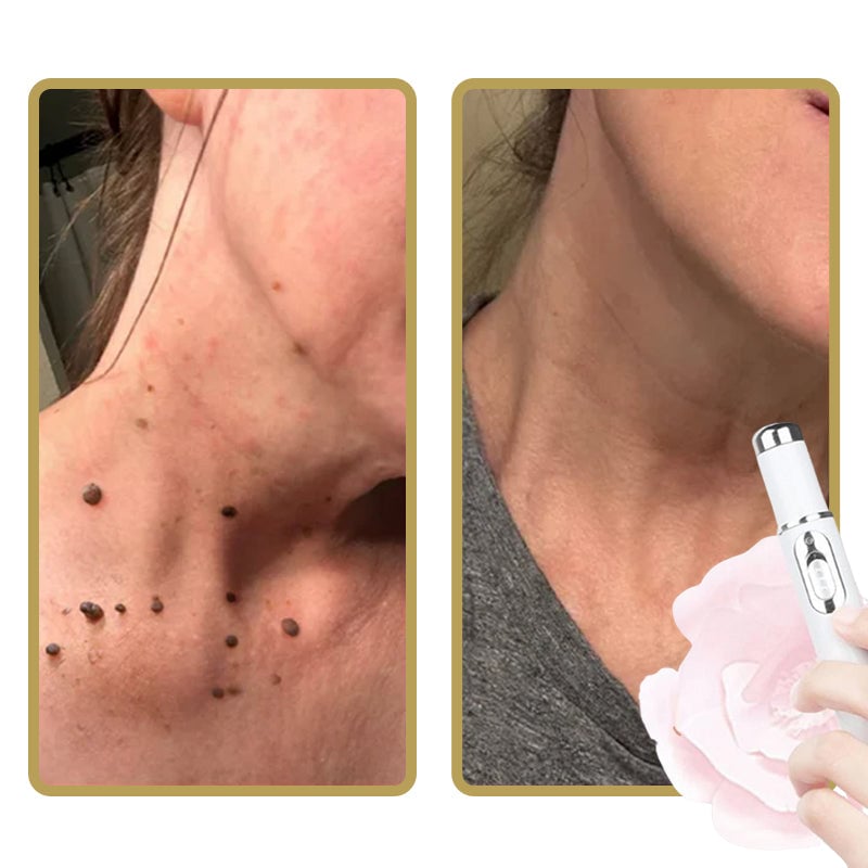 Skanto | ClearDerm - Rask, smertefri kvisefjerning for jevn, klar hud