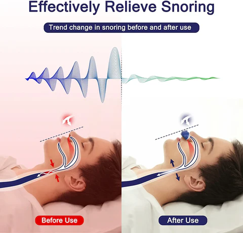 Skanto | Mikro CPAP Anti-Snorkeenhet | Maskeløs Søvnapnébehandling