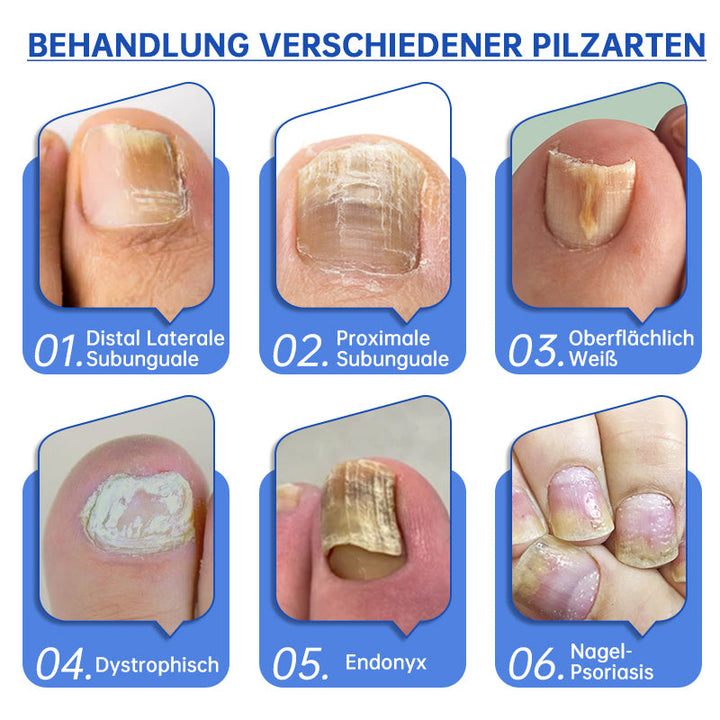 Skanto | PureNail™ | Neglesopp Laserbehandling Enhet - Ditt hemmelige våpen mot neglesopp