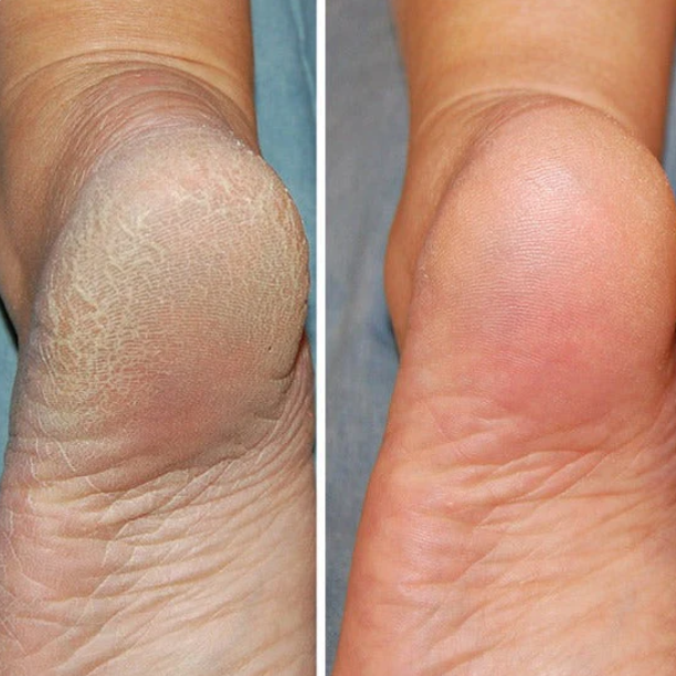 Norvo | Silicon-Spa-Sokker - Intensivpleie for sprukne og trøtte føtter