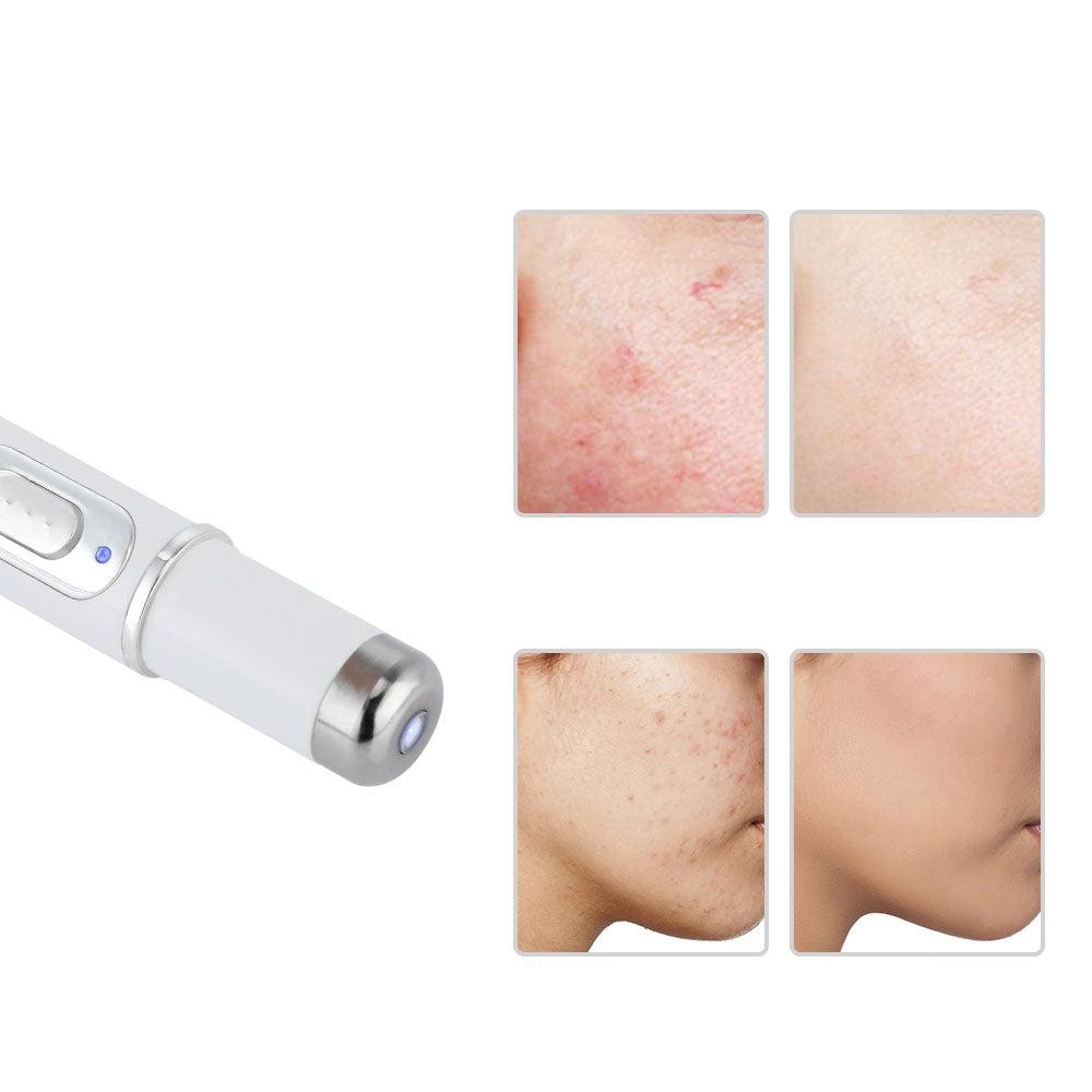 Skanto | LUCY – Laserpen med blått lys for presis behandling