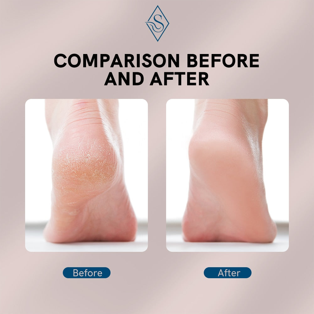 Electric Foot Callus Remover | Skanto