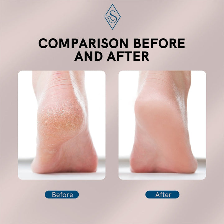 Electric Foot Callus Remover | Skanto