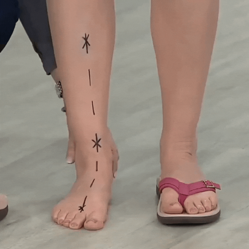 Norvo | Pylomo ortopediske sommersandaler – Smertelindring, bue støtte & holdningskorrigering