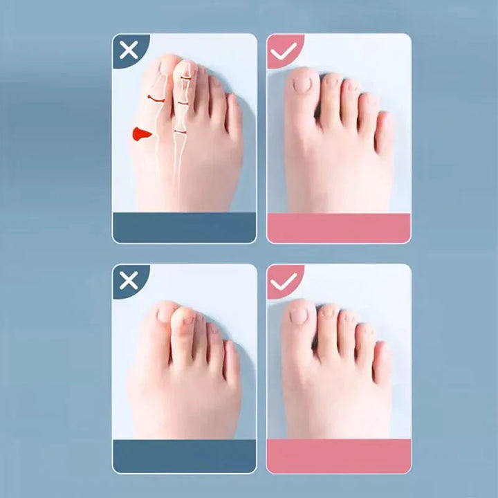 Skanto | Silikon Hallux Valgus Bunion Korrigerer