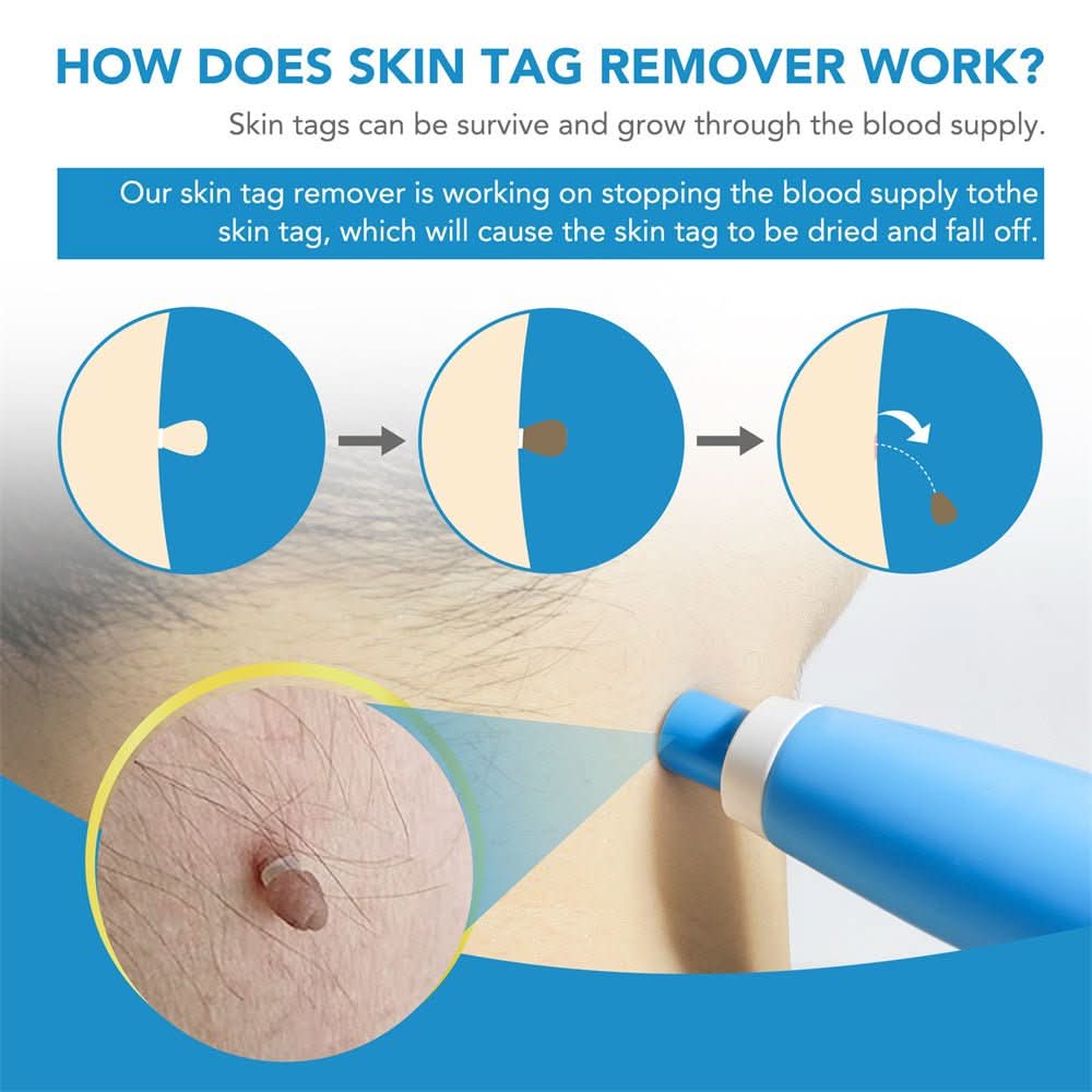 Skanto | DERMASWIFT – Hudflekkfjerner for Vorter & Hudflikter