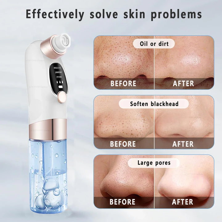 Skanto | Acne Black Head Deep Clean Removal