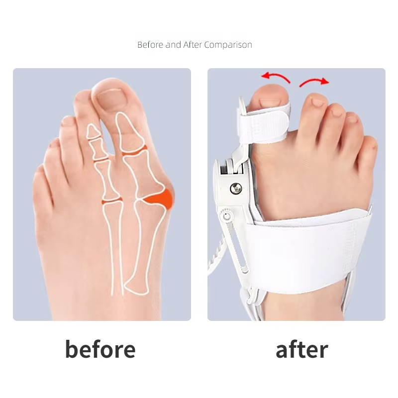 Skanto | Hallux Valgus Bunion Korrigerer Tå Separator Fot Justering Støtte