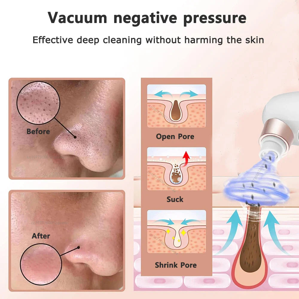 Skanto | Acne Black Head Deep Clean Removal