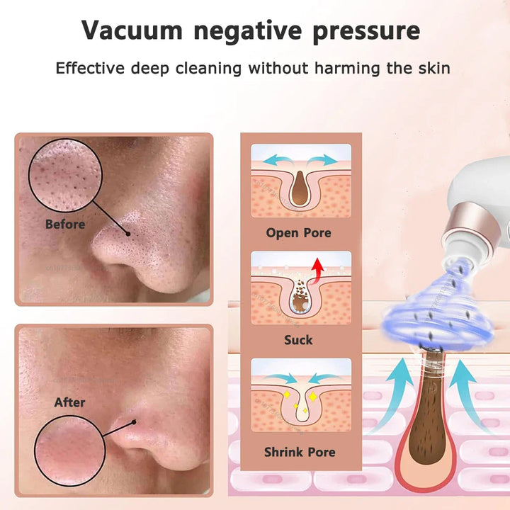 Skanto | Acne Black Head Deep Clean Removal