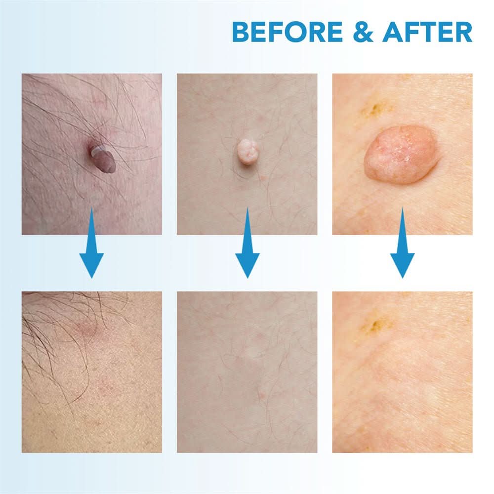 Skanto | DERMASWIFT – Hudflekkfjerner for Vorter & Hudflikter