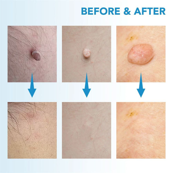 Skanto | DERMASWIFT – Hudflekkfjerner for Vorter & Hudflikter