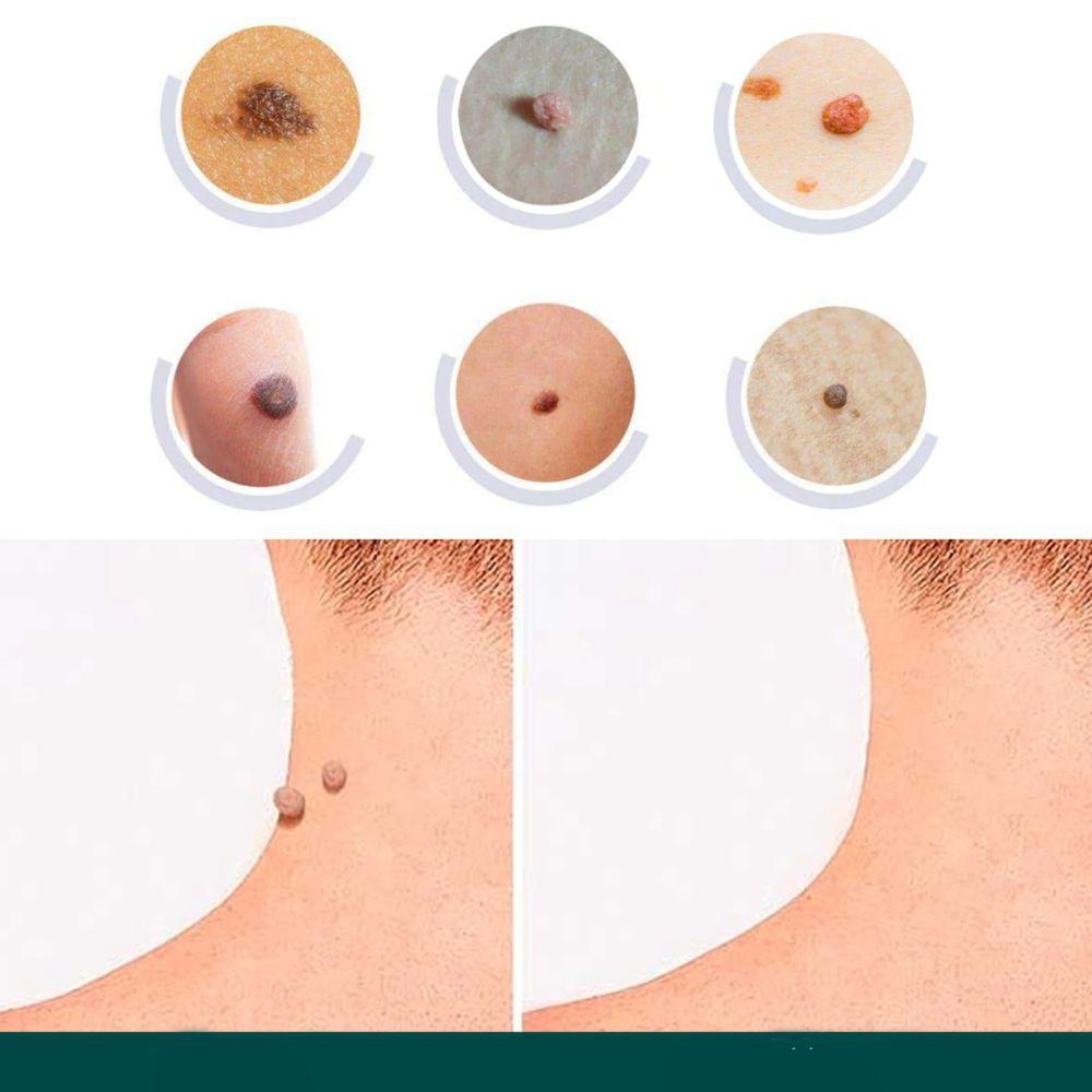 SkinClear - Patches for fjerning av flekker og vorter Skanto