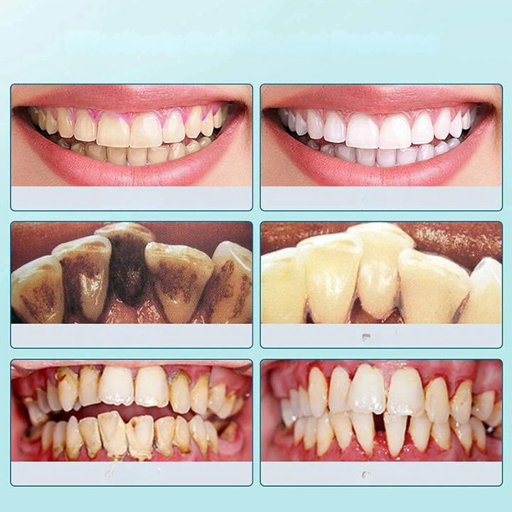 Skanto | SmilePro Ultrasonic Tannstein Rensesystem – Effektiv Plakkfjerner for Hjemmet