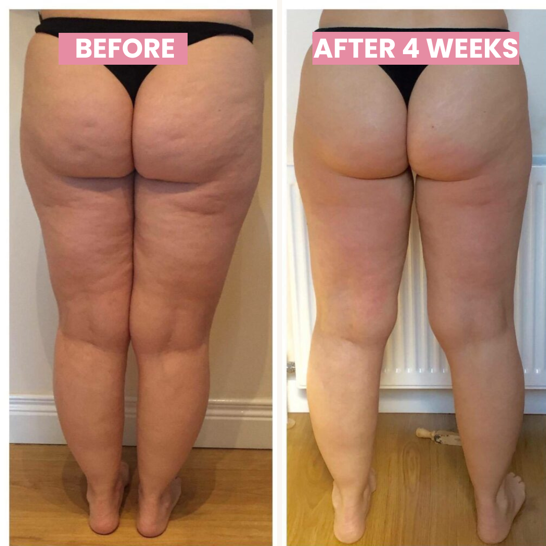 Skanto | Anti-cellulite Cupping-enhet - SlimCupp