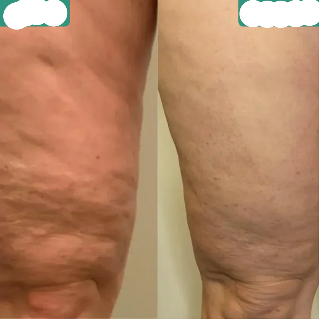 Skanto | Effektiv cellulittreduksjon og hudutglatting
