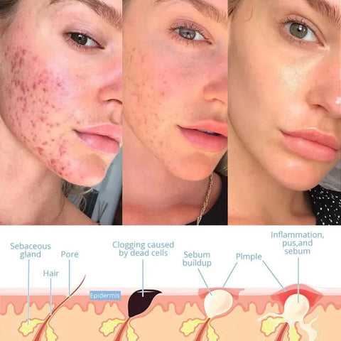 Skanto | Elysium Glow™ | Profesjonell høyfrekvent ansiktsstang | Anti-aldring hudforyngelsesapparat for hjemmebruk og spa-behandlinger