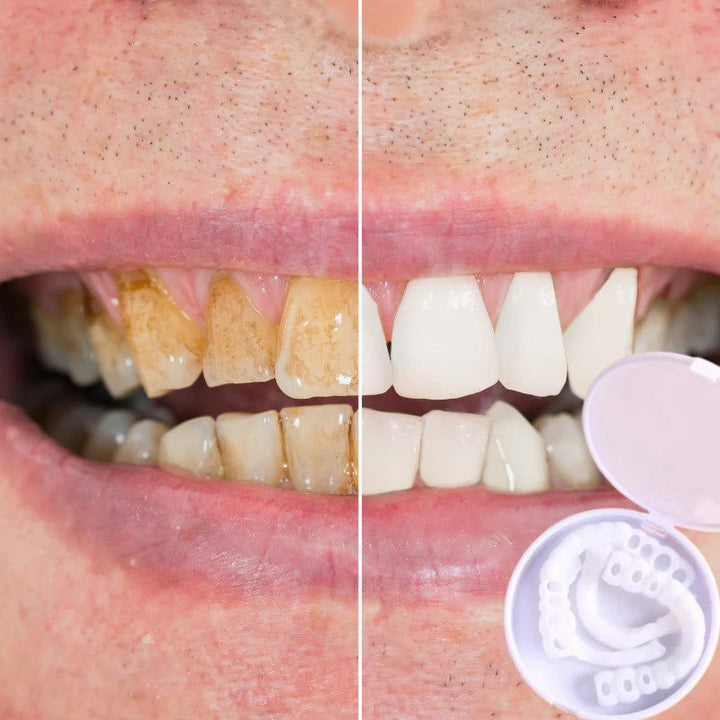 Skanto | Snap-on Teeth™ - Med disse fasettene, ha alltid det perfekte smilet