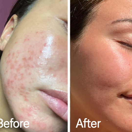 VitaleSkin Maske | Skanto