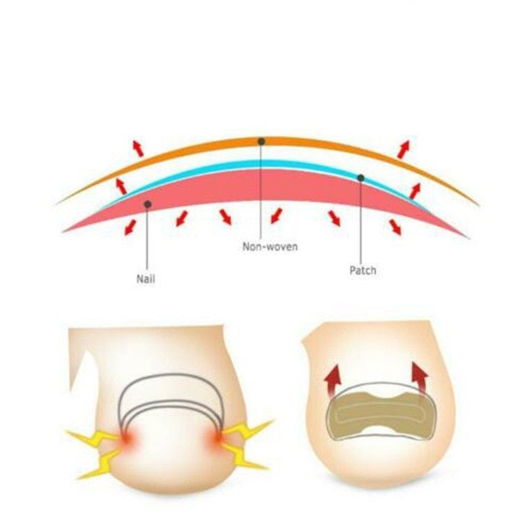 Skanto | Painless Toenail Patch - ToenailExpress