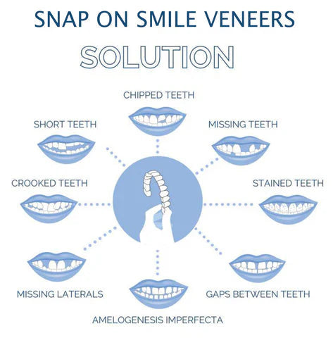Skanto | Smile Veneer (Øvre & Nedre Inkludert)